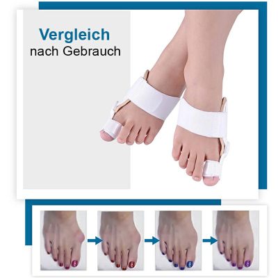 Orthopädischer Bunion-korrektor