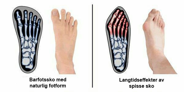 Barfußschuhe – Wie sich Barfußschuhe von herkömmlichen Schuhen unterscheiden